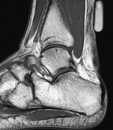 Figure 3 for case Achilles tendon tear and calcaneonavicular coalition (RID3801)(RID3184)